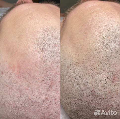 Трихопигментация для мужчин и женщин