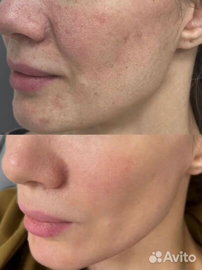 Микроигольчатый RF лифтинг косметолог омоложение