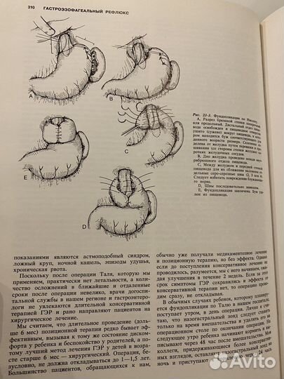 Детская хирургия, Ашкрафт, Холдер