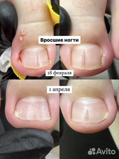 Лечебный педикюр, подолог