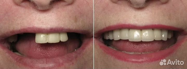 Частичный съемный протез