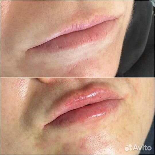 Контурная пластика губ