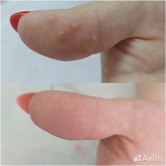 Удаление папиллом, жировиков, бородавок, гемангиом