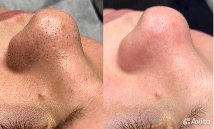 Косметолог Чистка лица