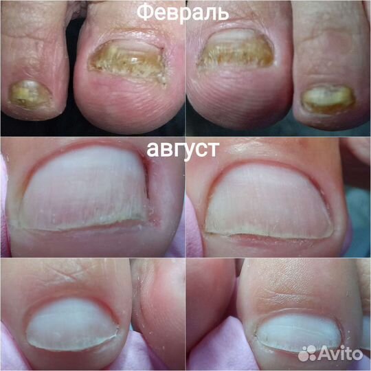 Аппаратный маникюр