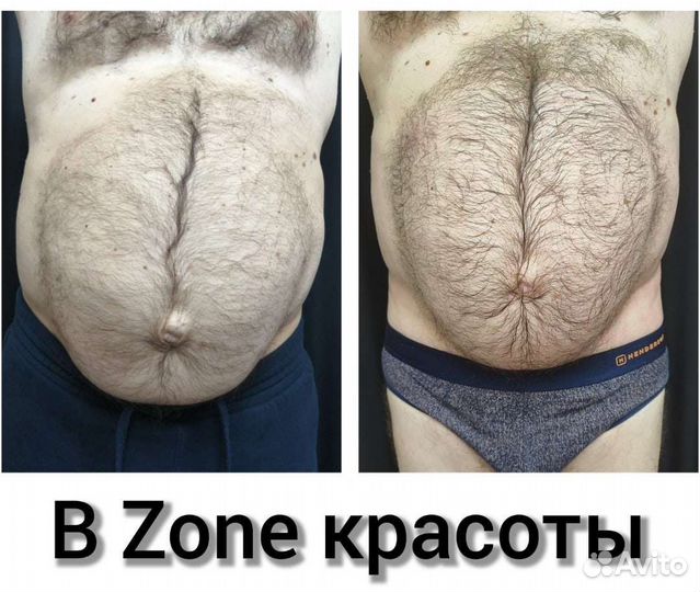 Курс жиротоп,модели на подтяжку живота