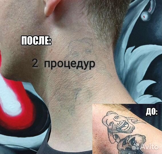 Удаление татуировок