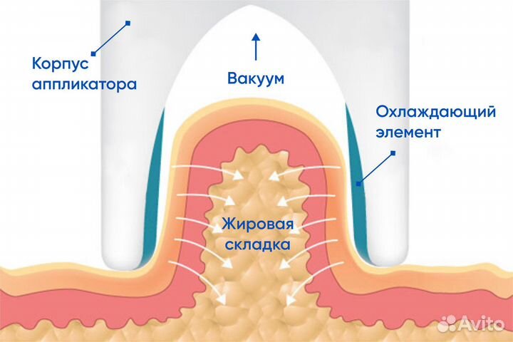 Криолиполиз Похудение заморозка лишнего веса