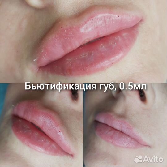 Бьютификация губ