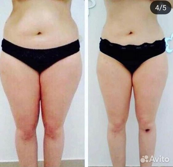 LPG массаж Аппаратный массаж