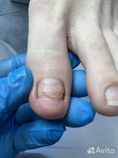 Отслоение Травмированный ноготь Подолог