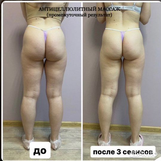 Антицеллюлитный массаж/ оздоровительный