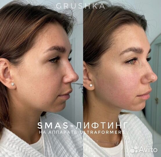 Смас лифтинг ультраформер подтяжка лица