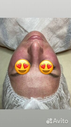 Капиляротерапия