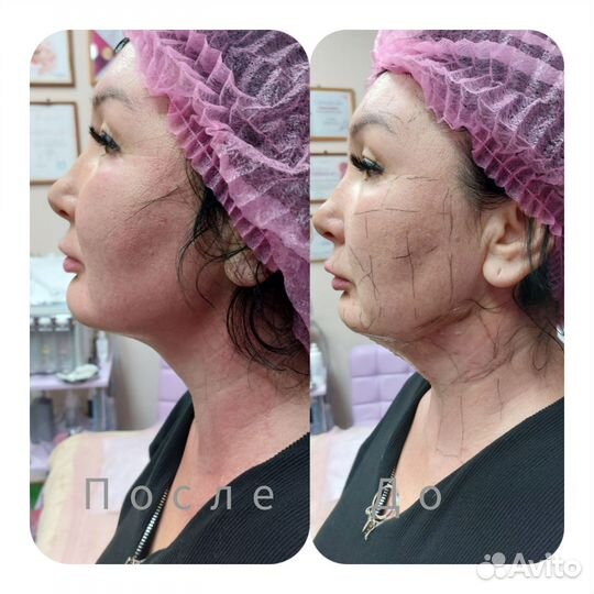 Аппаратная косметология