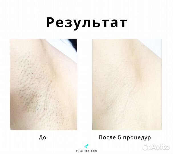 Аппарат для эпиляции люминес Макс-Ван 1200вт