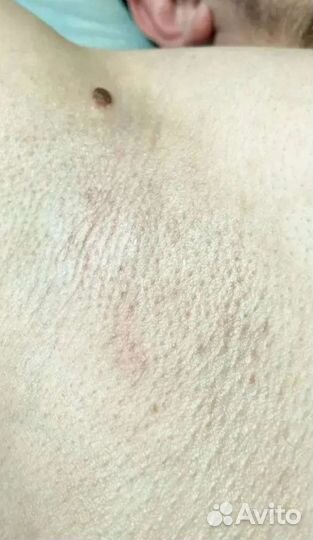 Депиляция воском