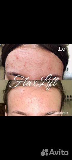 Flaxlift