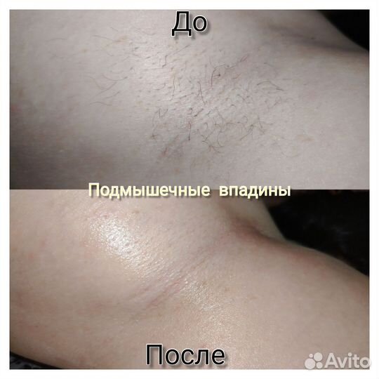 Женский Шугаринг