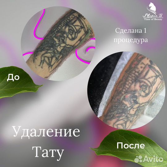 Удаление тату и Перманента