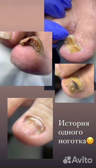 Подолог.Москва.Медицинский педикюр.Вросший ноготь