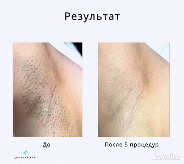 Аппарат для эпиляции Люминес. MaxPlus 2000в