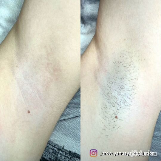 Нужны модели/Восковая депиляция