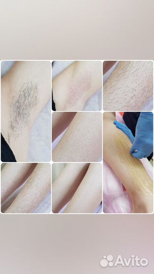 Обучение,базовые курсы по депиляции