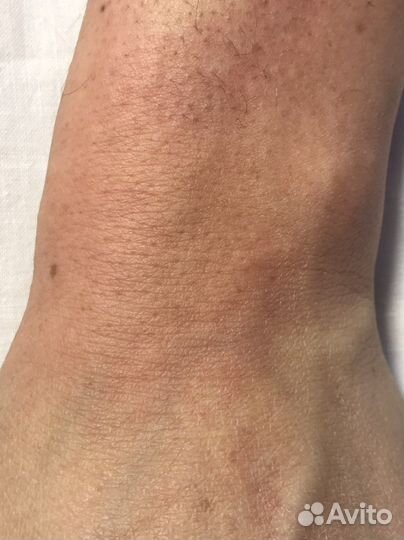 Электроэпиляция: бёдра