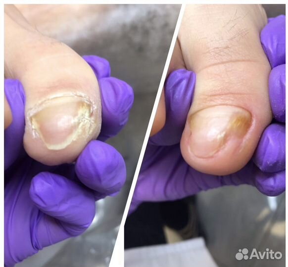 Подолог. Медицинский,Smart педикюр.Сланцы Гдов