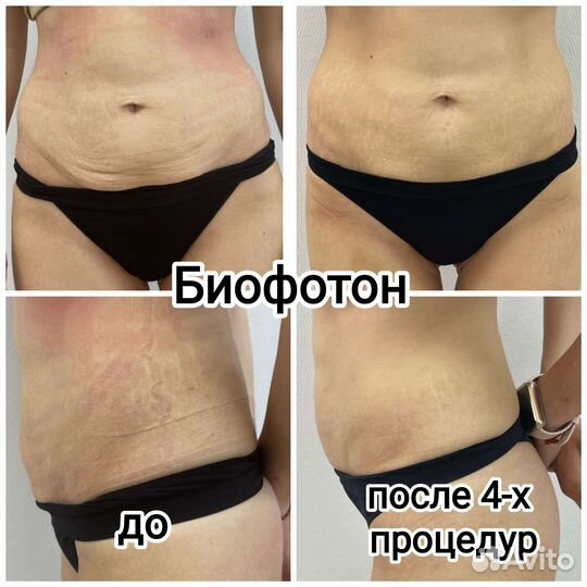 Кавитация, смас-лифтинг, RF- лифтинг, биофотон