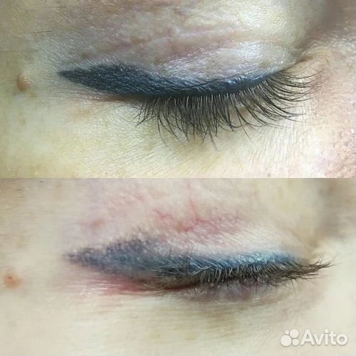 Удаление татуажа бровей, губ и стрелок