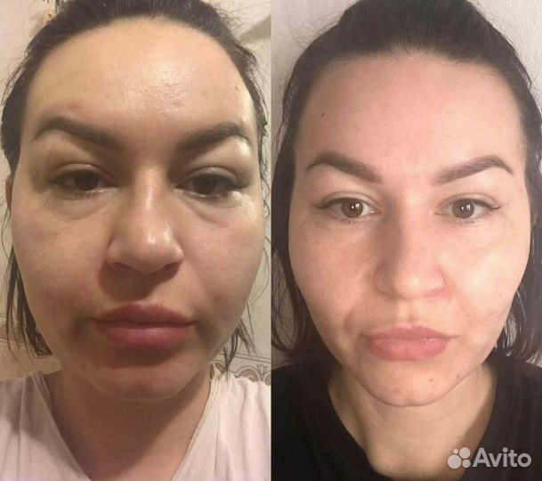 Средство от отёков