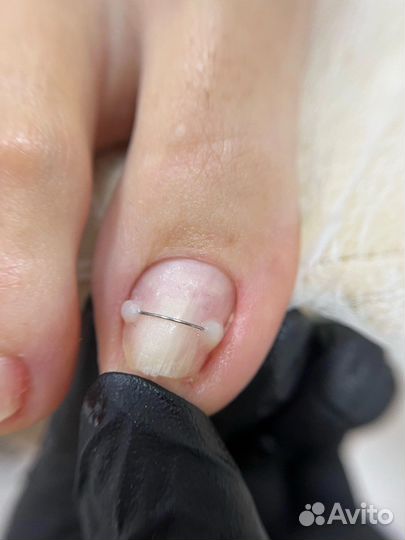 Подология медицинская обработка стоп и ногтей