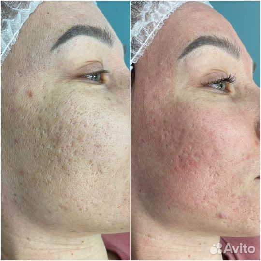 Лазерная шлифовка с охлаждением