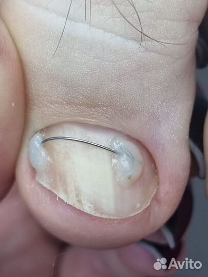 Титановая нить, Вросший ноготь. Подолог