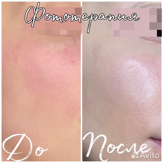 Косметолог: чистка, пилинг, мезотерапия