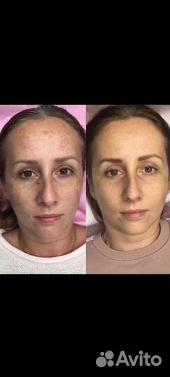 Flaxlift