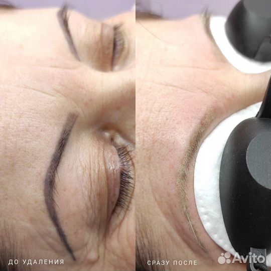 Удаление татуажа и татуировок