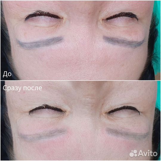 Лазерное удаление татуажа