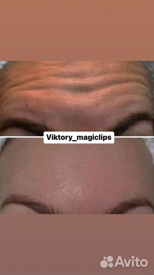 Ботокс для лица