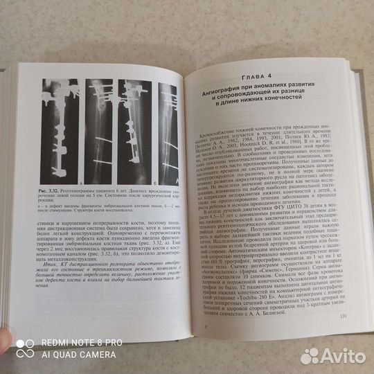 Неравенство длины нижних конечн. у детей, Малахов