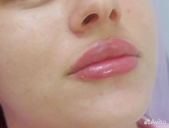 Увеличение губ