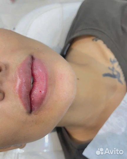 Увеличение губ (Швейцария, Корея, Франция)