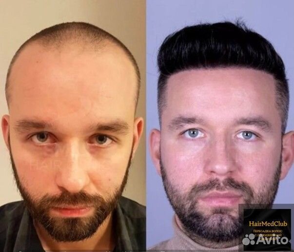Пересадка волос Качество/ Гарантия/ Результат