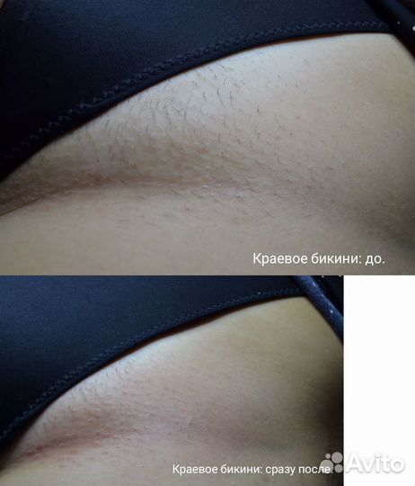 Электроэпиляция