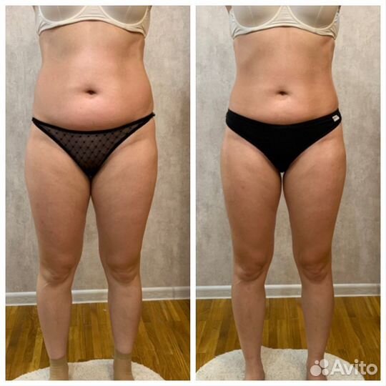 Антицеллюлитный массаж