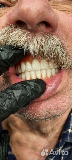 Зубные протезы