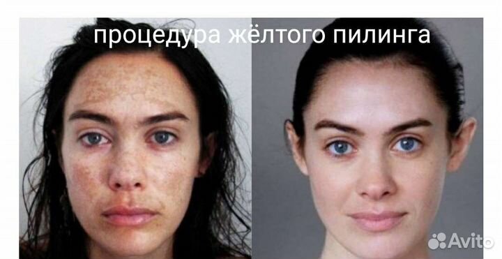 Мезотерапия. Липолитики. Хиромассаж, пилинги