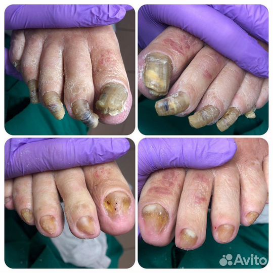 Подолог. Медицинский педикюр. Титановая нить